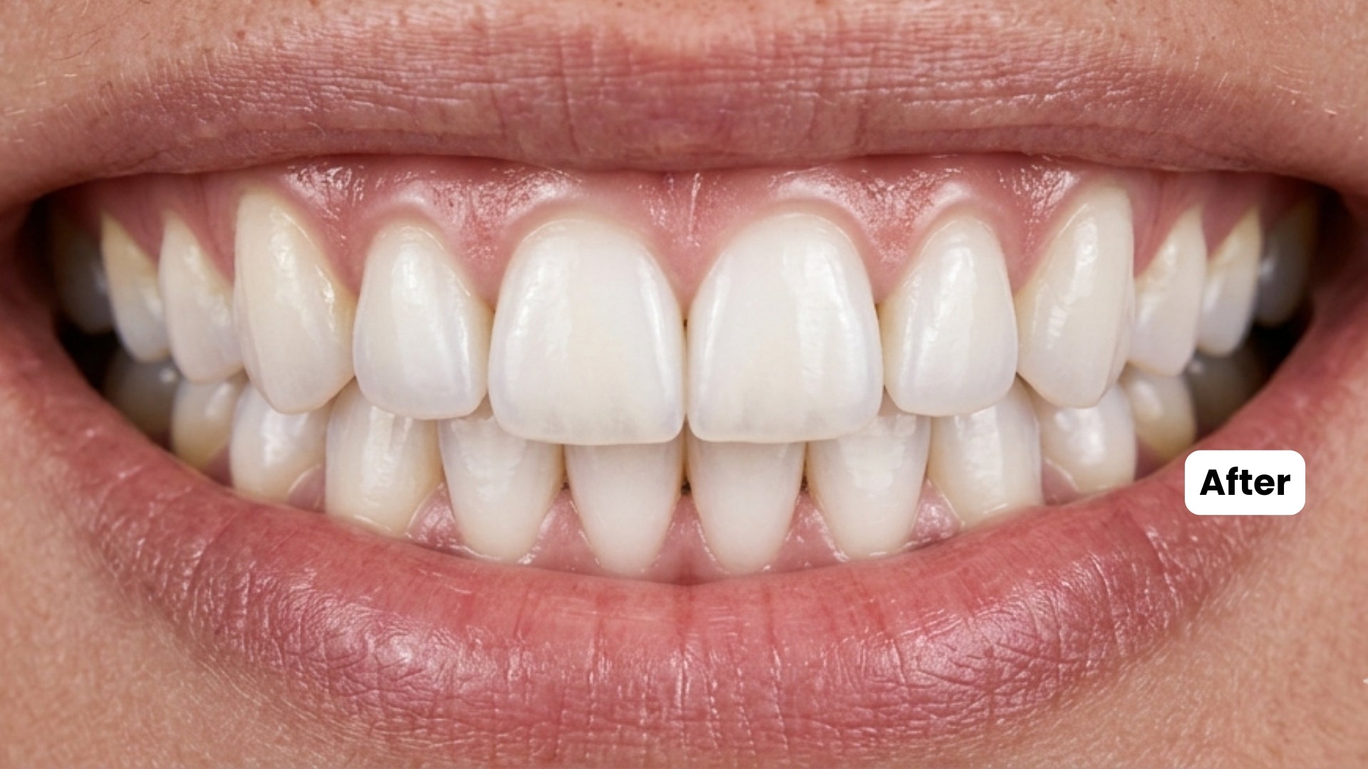 Before teeth whitening